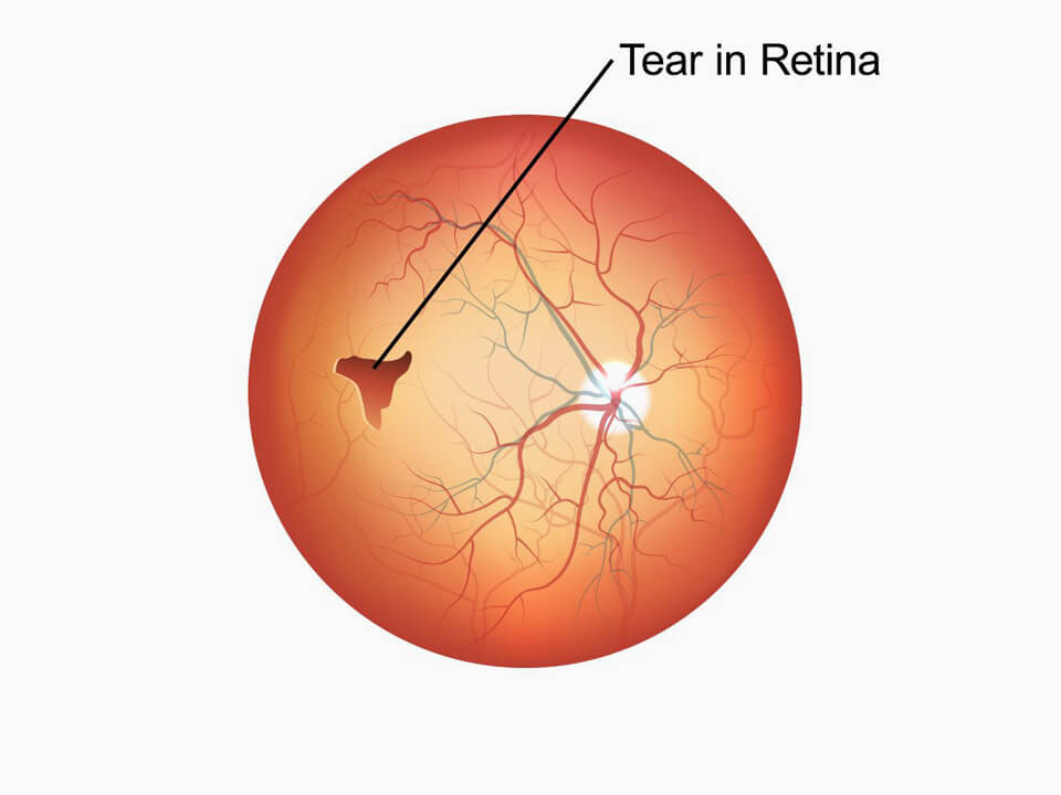 how-do-i-know-if-i-have-a-torn-or-detached-retina-retina-associates