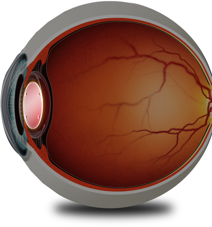 what-are-the-leading-risk-factors-for-retinal-detachment-retina